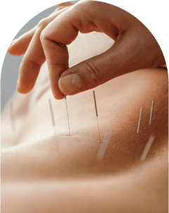 Acupuncture